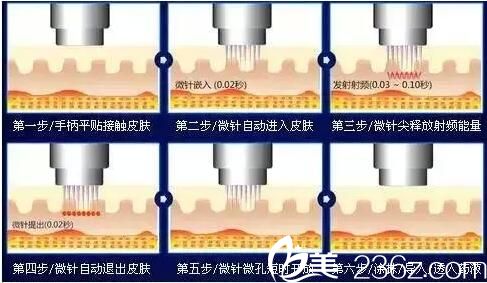 黃金點陣射頻和熱瑪吉的區(qū)別