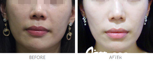 埋線提升對比圖