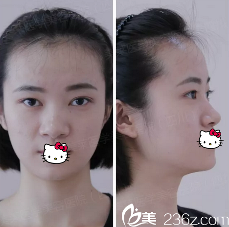 自體肋軟骨隆鼻術前照片 自體肋軟骨隆鼻術前照片