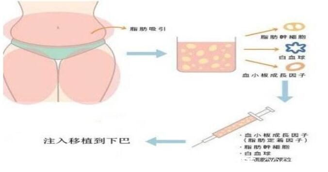 自體脂肪墊下巴過(guò)程