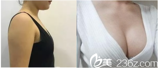 北京<!--<i data=20240703-sp></i>-->假體隆胸