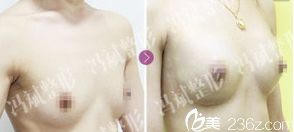 <!--<i data=20240703-sp></i>-->和諧脂肪豐胸