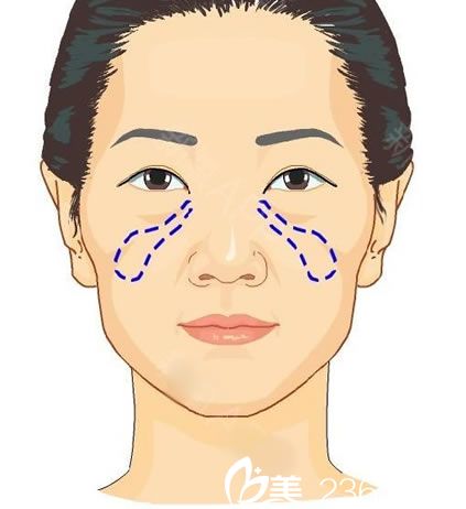 臉上蘋(píng)果肌下垂怎么辦