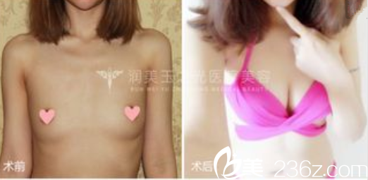 北京潤美玉之光脂肪豐胸