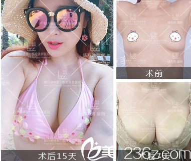 北京聯(lián)合麗格脂肪豐胸