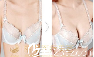 北京米蘭柏羽麗都假體隆胸