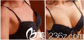 北京<!--<i data=20240703-sp></i>--><!--<i data=20240703-sp></i>-->脂肪豐胸