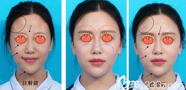 溫州芘麗芙玻尿酸豐蘋(píng)果肌案例