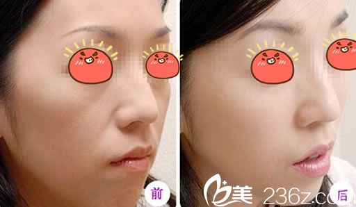 溫州芘麗芙自體脂肪填充蘋(píng)果肌案例