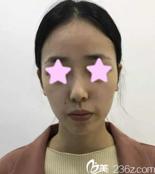 我在長治悅美整形美容醫(yī)院做鼻綜合前的照片 我在長治悅美整形美容醫(yī)院做鼻綜合前的照片