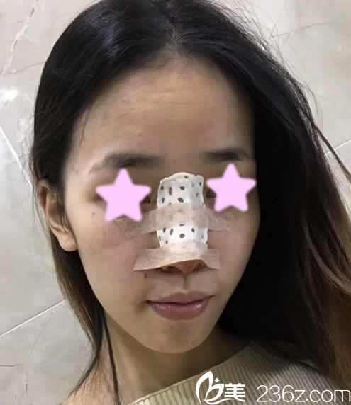 我在長治悅美整形做鼻綜合隆鼻后第3天的照片 我在長治悅美整形做鼻綜合隆鼻后第3天的照片