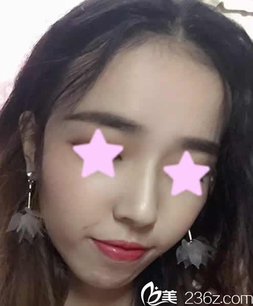 我找長治悅美整形薛艷峰做鼻綜合術(shù)后第10天照片 我找長治悅美整形薛艷峰做鼻綜合術(shù)后第10天照片