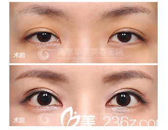 南京華美雙眼皮過(guò)寬修復(fù)案例 南京華美雙眼皮過(guò)寬修復(fù)案例