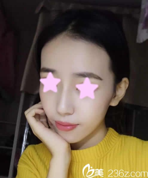 說(shuō)說(shuō)我找長(zhǎng)治悅美整形薛艷峰院長(zhǎng)做鼻綜合價(jià)格及術(shù)后18天恢復(fù)效果