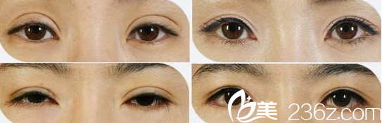 失敗雙眼皮修復案例對比圖