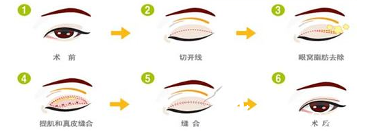 雙眼皮修復手術方法