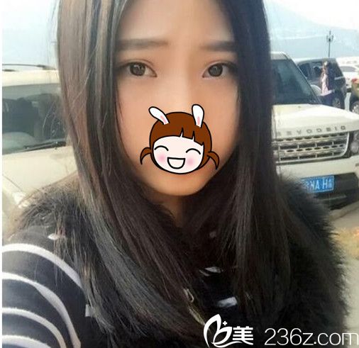 本想做歐式大平行雙眼皮，但常州美貝爾醫(yī)生說我更適合7mm小平行芭比大眼