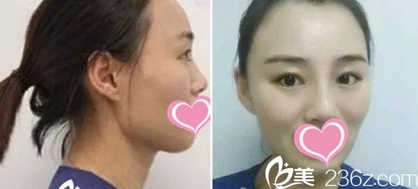 青?？等A雙眼皮手術(shù)案例