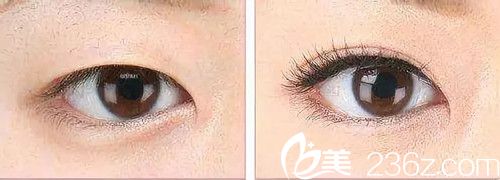 雙眼皮手術(shù)不對(duì)稱怎么修復(fù)