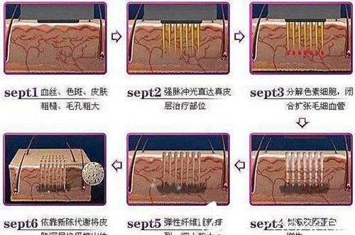 光子嫩膚適用皮膚各個部位