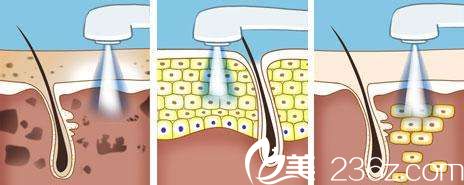 光子嫩膚工作原理