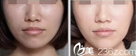 光子嫩膚祛除面部暗黃案例