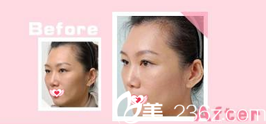 光子嫩膚抗衰老作用