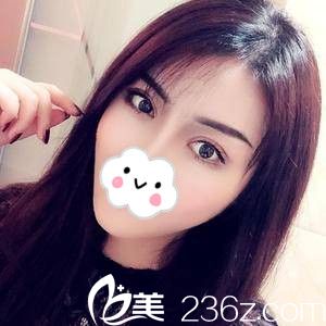 猶豫了好久，較后還是找哈爾濱雙燕的黃澤春主任做了全切雙眼皮，一個(gè)月后閉眼無痕連我自己都不敢相信