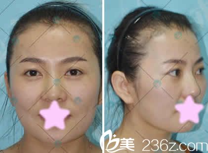 我在大同清木整形做線雕提升前的照片 我在大同清木整形做線雕提升前的照片