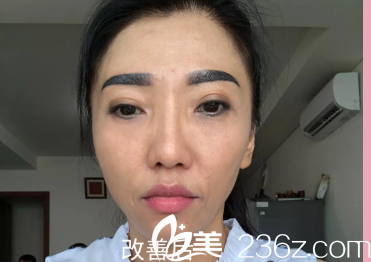 濟(jì)南去眼袋手術(shù)價(jià)格是3000元起，我做的內(nèi)切去眼袋感覺不是很貴