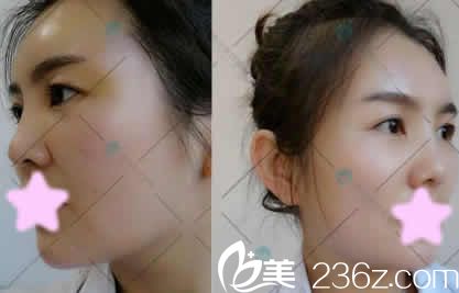 我在大同清木整形做全臉線雕提升后第3天照片 我在大同清木整形做全臉線雕提升后第3天照片