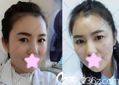  80后的我在大同清木整形做全臉線雕提升術恢復一周后美過18歲，大家都說這錢花的值