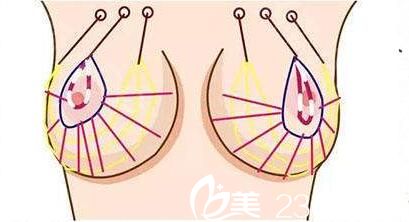 自體脂肪隆胸效果好不好？