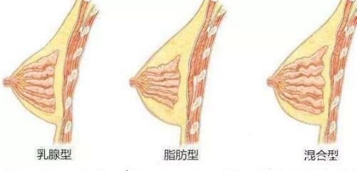 自體脂肪隆胸需要做幾次？