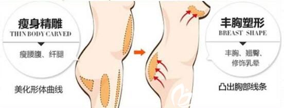自體脂肪隆胸能被吸收多少？