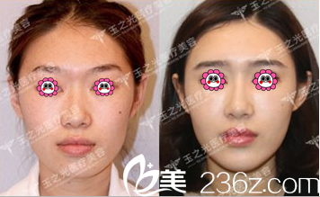 北京潤(rùn)美玉之光面部吸脂實(shí)例