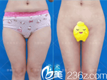 北京京韓腿部吸脂