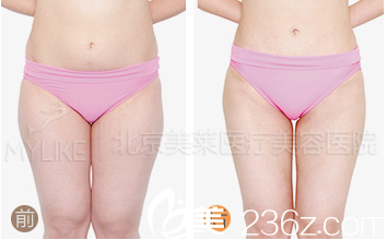 北京美萊腰腹部和腿部吸脂