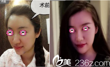 北京華韓面部吸脂