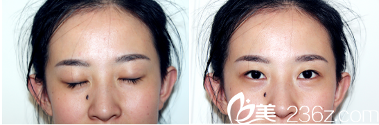 看我術(shù)前照片是不是很喜慶 看我術(shù)前照片是不是很喜慶