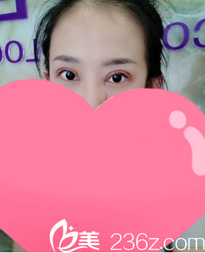 剛做完的時(shí)候真的是腫成狗了 剛做完的時(shí)候真的是腫成狗了