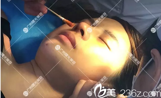 廣州曙光郭建隆鼻案例術(shù)后7天拆線 廣州曙光郭建隆鼻案例術(shù)后7天拆線