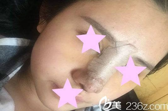 硅膠假體隆鼻手術第1天