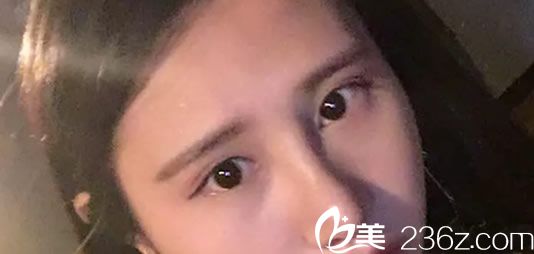 做完鼻綜合7天恢復效果