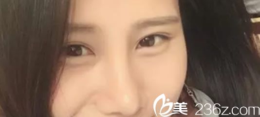 鼻綜合術后10天照片