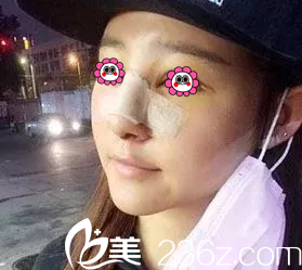 北京美萊做鼻修復(fù)第4天樣子 北京美萊做鼻修復(fù)第4天樣子