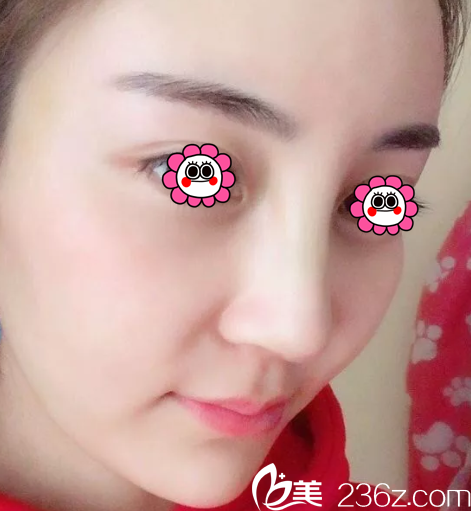 北京美萊鼻修復(fù)案例 北京美萊鼻修復(fù)案例