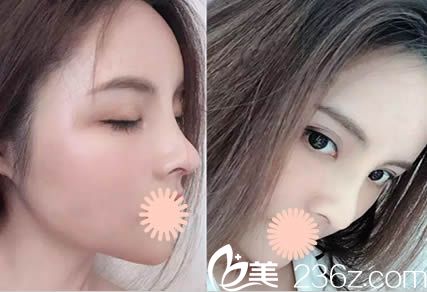 韓國清潭整形醫(yī)院怎么樣？奉上李丙玟院長鼻部整形和全臉脂肪填充真實案例