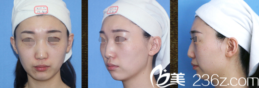 注射隆鼻下巴術前.png 注射隆鼻下巴術前.png