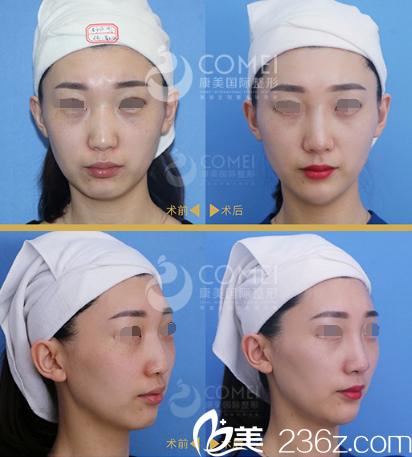 剛注射寶尼達玻尿酸隆鼻豐下巴術后即刻 剛注射寶尼達玻尿酸隆鼻豐下巴術后即刻